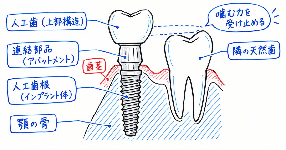 インプラントの構造を、骨から歯の先までたどる