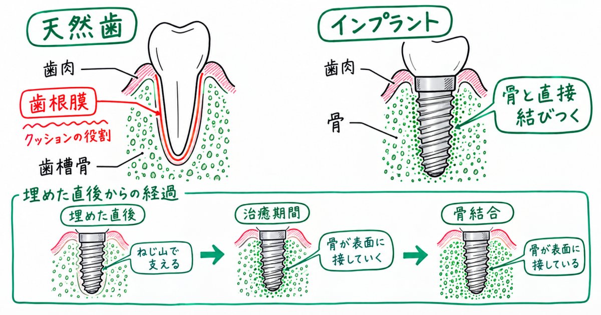 インプラントが骨に固定される仕組みと、天然歯との違い