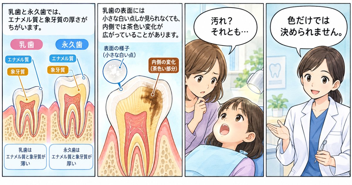 乳歯のむし歯が早く進みやすい理由と、白い変化の見方